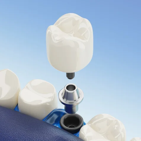 Dental Implants